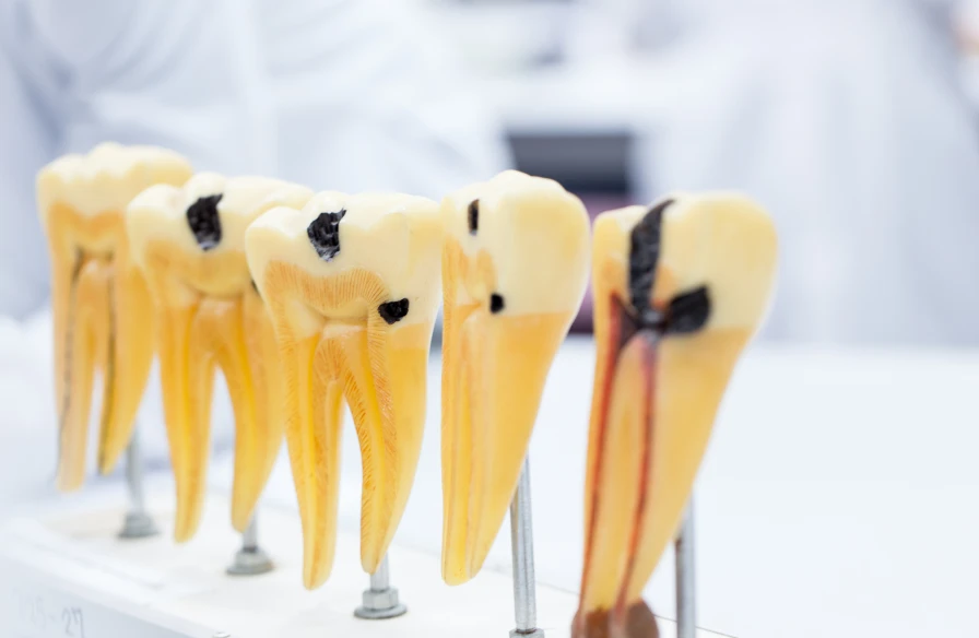 caries abces dentiste caries abces dentiste - Abcès dentaire