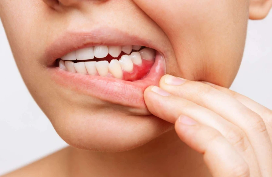 cause perte dents cause perte dents - Perte de dents - République du Sourire | Dr Kouassi