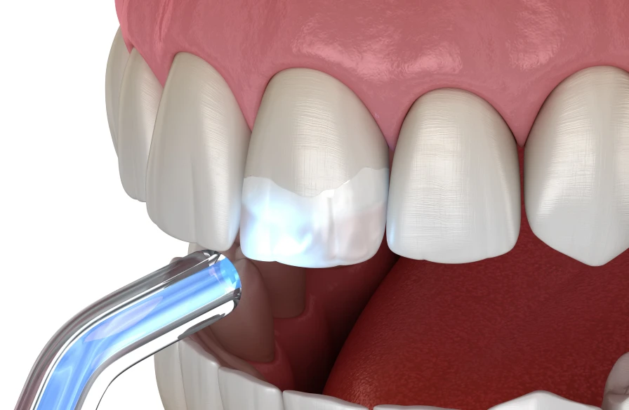 composite kouassi dentiste - Esthétique