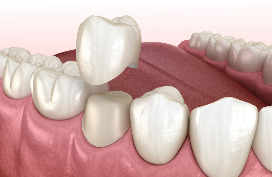 couronne dentaire - Soins conservateurs
