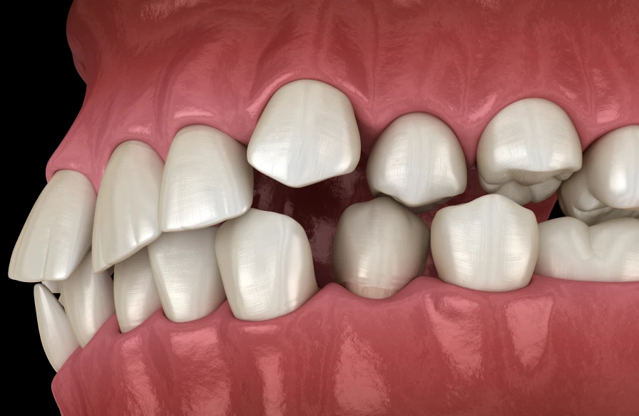dents mal alignees traitement dentiste kouassi - Dents mal alignées