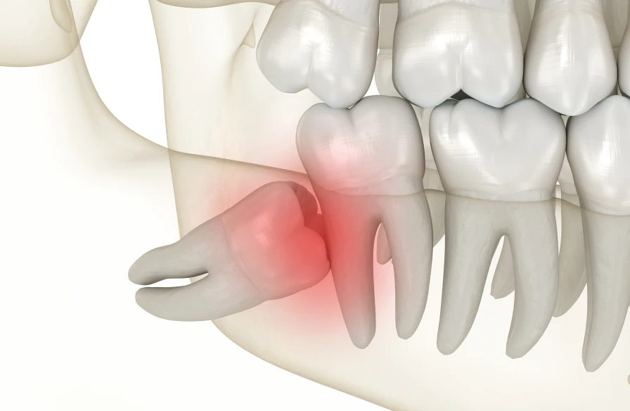 dents sagesse - Soins conservateurs