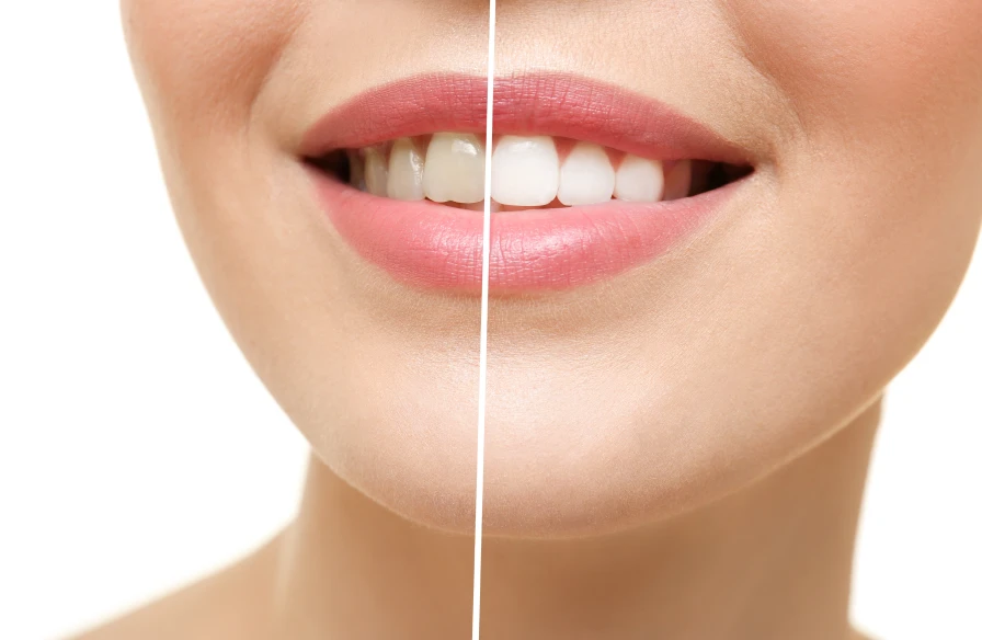 eclaircissement dentaire kouassi dentiste eclaircissement dentaire kouassi dentiste - Taches dentaires