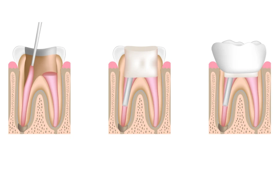 endodontie dentiste kouassi 1 - Endodontie