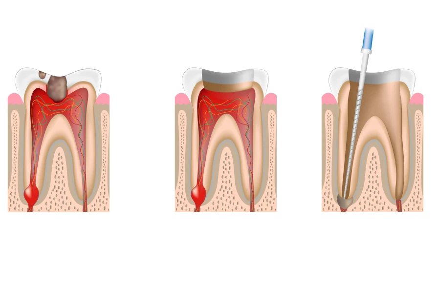 endodontie kouassi dentiste - Endodontie