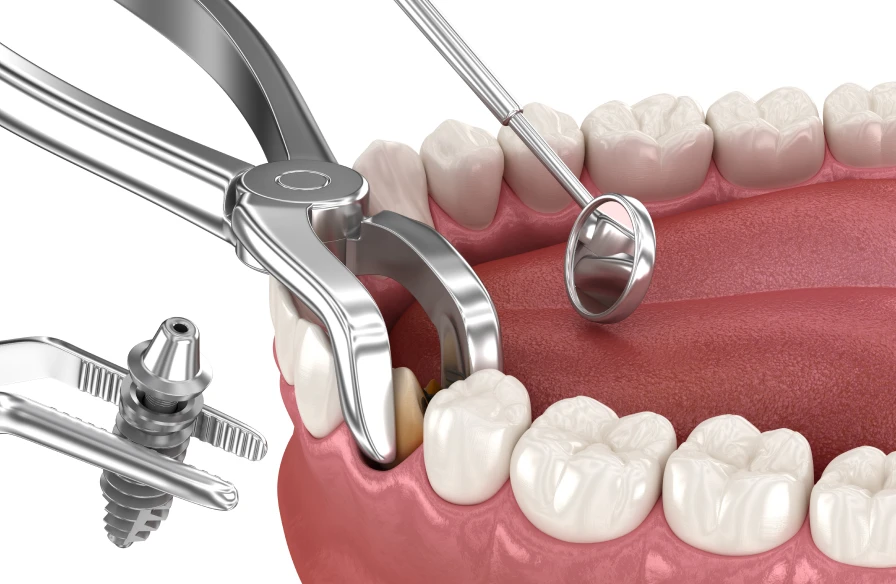 extraction implantation kouassi dentiste - Implantologie