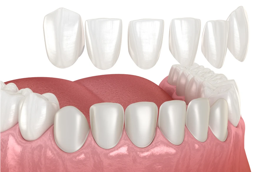 facettes dentiste kouassi - Esthétique