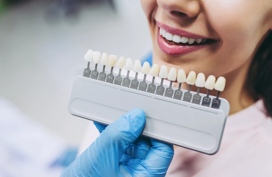 facettes esthetique dentiste - Esthétique