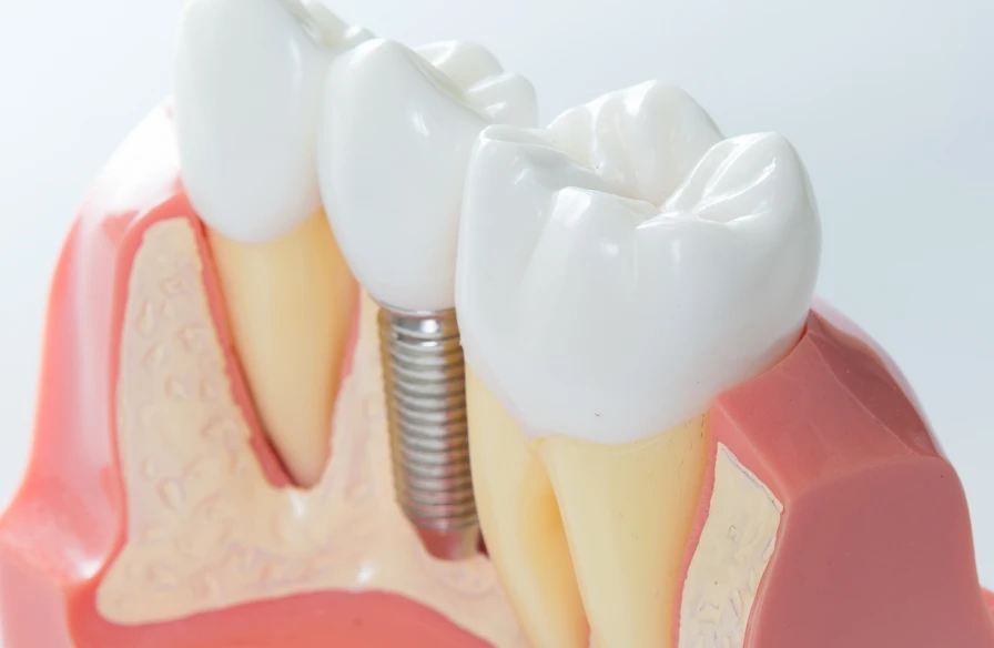 implant dentaire dentiste kouassi - Implantologie