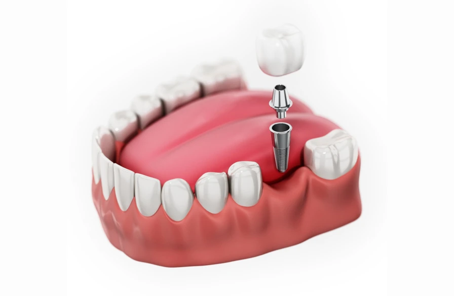implant dentaire kouassi - Implantologie