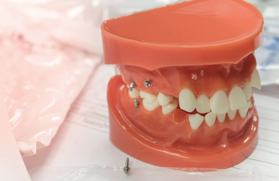 mini vis orthodontique - Orthodontie