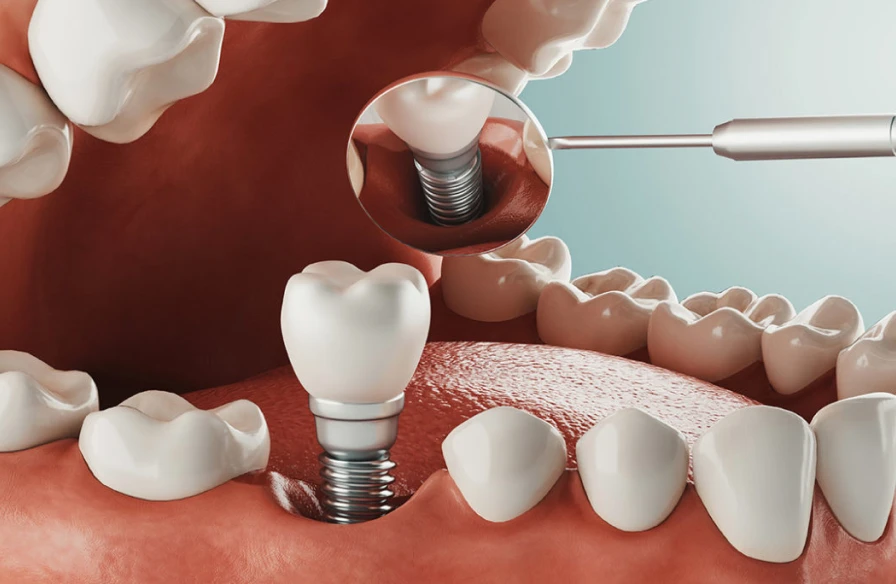 pertt dents implant solution pertt dents implant solution - Perte de dents - République du Sourire | Dr Kouassi