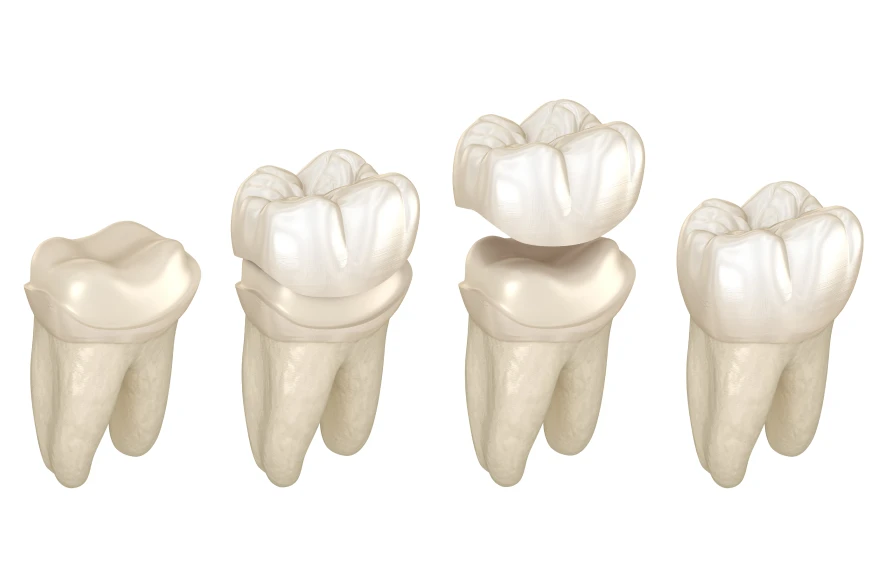 pose couronne dentiste kouassi - Perte d'une couronne