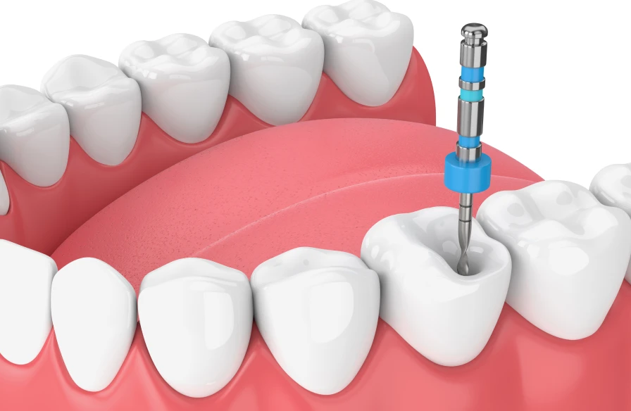 retraitement endodontique - Endodontie