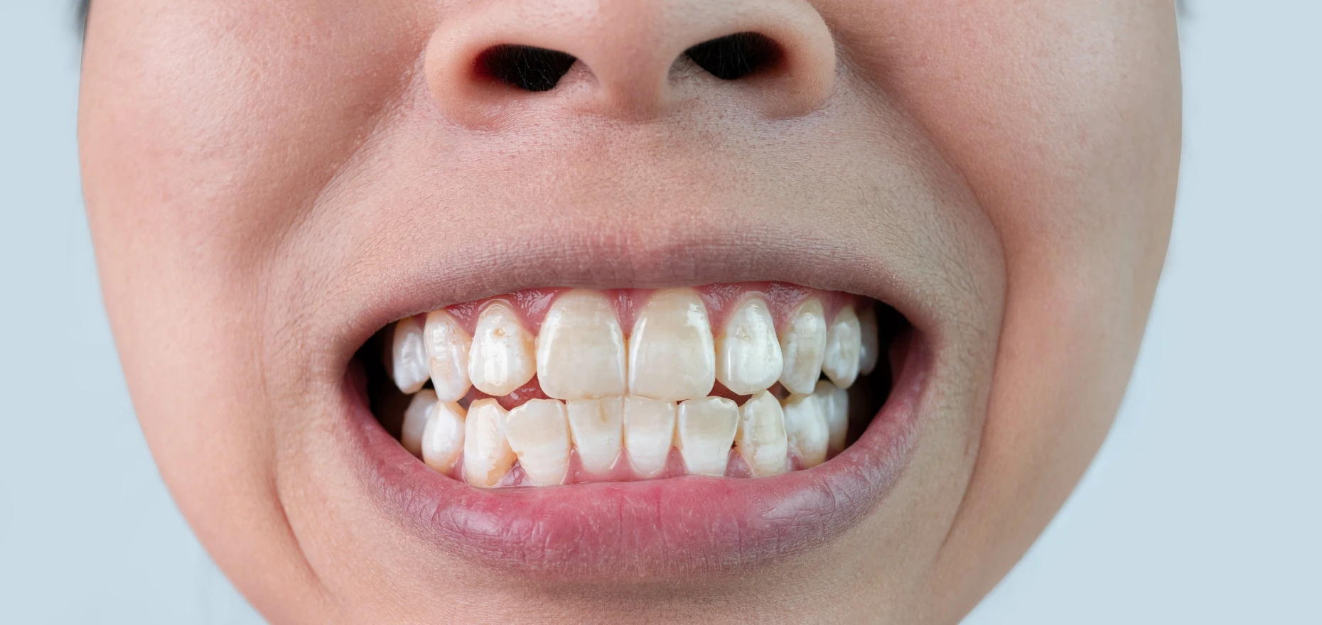 taches dents traitements dentiste kouassi taches dents traitements dentiste kouassi - Taches dentaires
