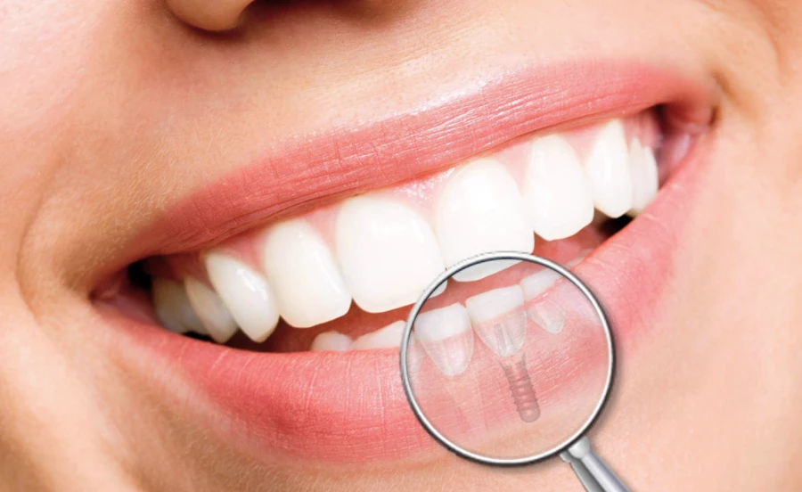 Implant : conseils avant et après
